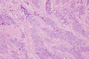 This carcinoma shows no tubule formation whatsoever - Tubule score = 3